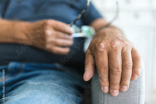 Elderly man suffering from psoriasis on hands