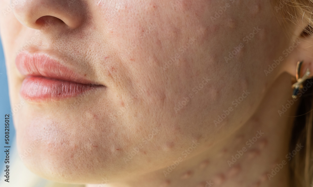 Real biorevitalization of the skin on a white background. Traces of injections of biorevitalization on the face of a woman. Traces of biorevitalization needles. Real biorevitalization of the skin on a white background. Traces of injections of biorevitalization on the face of a woman. Traces of biorevitalization needles.