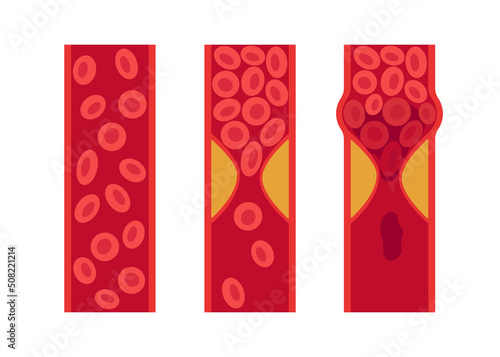 Normal and cholesterol-blocked artery. Blood clot, thrombus, atherosclerotic plaque. Deep vein thrombosis DVT or arterial clot, blood vascular flow. Blocked circulation in blood vessel. Vector