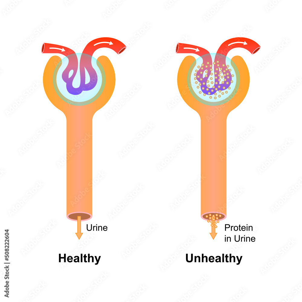 Scientific Designing Of Diabetic Nephropathy Common Complication Of