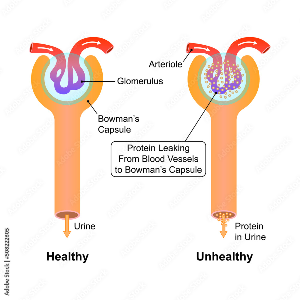 Scientific Designing Of Diabetic Nephropathy Common Complication Of scientific-designing-of-diabetic-nephropathy-common-complication-of