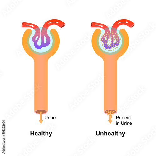 Scientific Designing of Diabetic Nephropathy. Common Complication of Type 1 and Type 2 Diabetes. Colorful Symbols. Vector Illustration. photo
