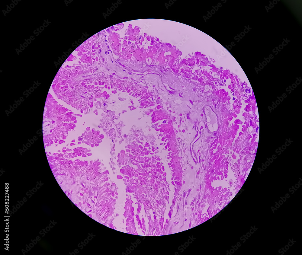 Histology of metastatic papillary adenocarcinoma. Histology of metastatic papillary adenocarcinoma.