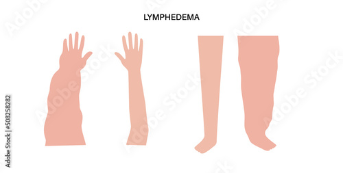 Obraz na płótnie Lymphedema of arm and leg