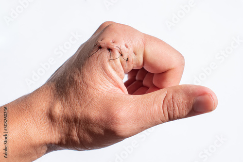Hand injured by a cut. Surgical suture made by a surgeon. Cut in the hand with knife, scissors, cutting element.