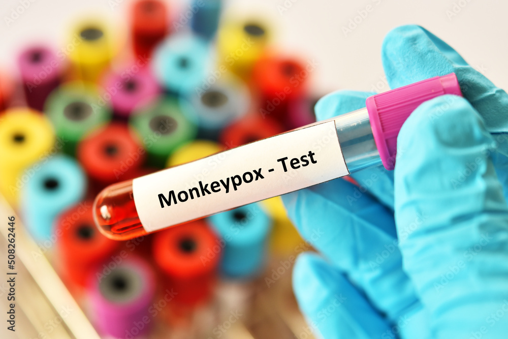 Obraz premium Blood sample tube for Monkeypox virus test, new epidemic disease in 2022