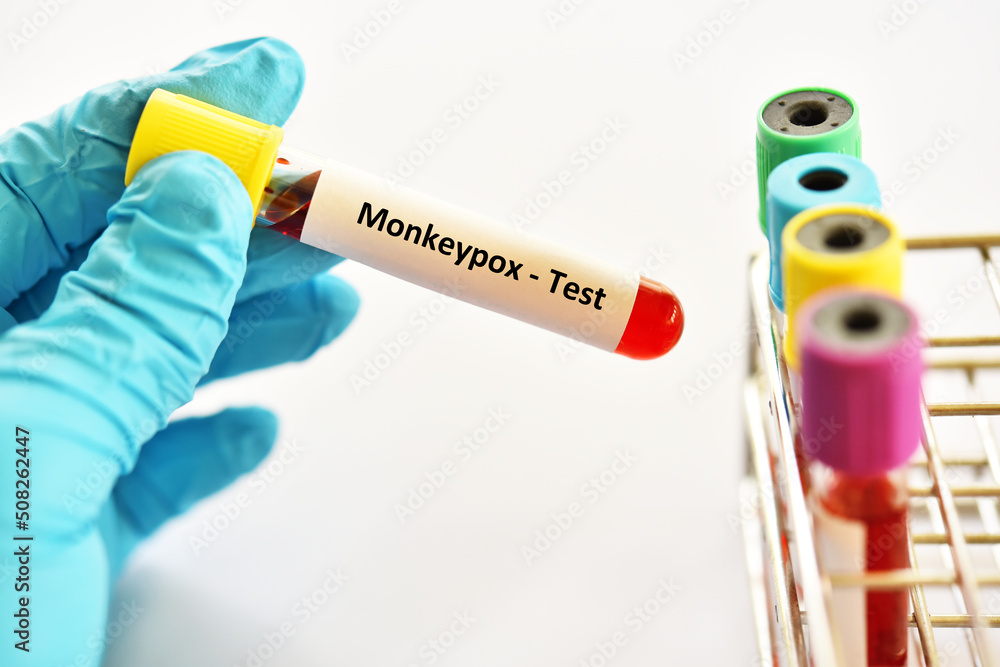 Blood sample tube for Monkeypox virus test, new epidemic disease in ...