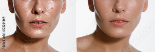 before and after excision of a nevus spots on a woman's cheek with a laser in a cosmetology clinic, close-up, details photo