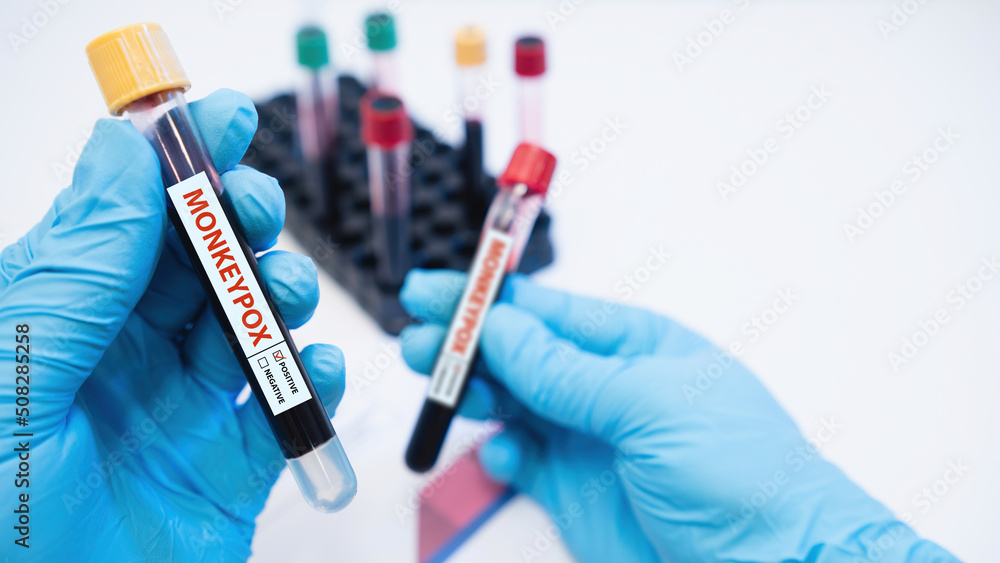hand holding blood collection tubes and data sheet on monkeypox test positive results in laboratories. hand holding blood collection tubes and data sheet on monkeypox test positive results in laboratories.