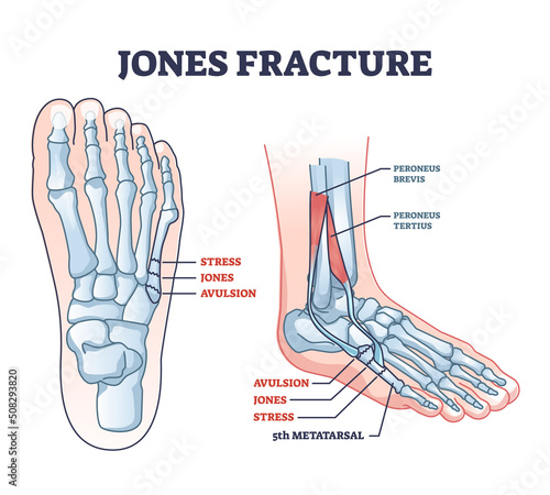 Jones fracture and foot pinky finger bone broken damage outline diagram. Labeled educational scheme with bone stress or avulsion sections vetor illustration. Peroneus brevis and tertius muscle anatomy photo
