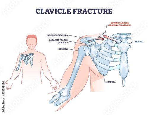 Clavicle fracture anatomy and broken shoulder collarbone outline diagram. Labeled educational scheme with anatomical hand and scapula skeletal joint vector illustration. Acromion and coracoid process. photo