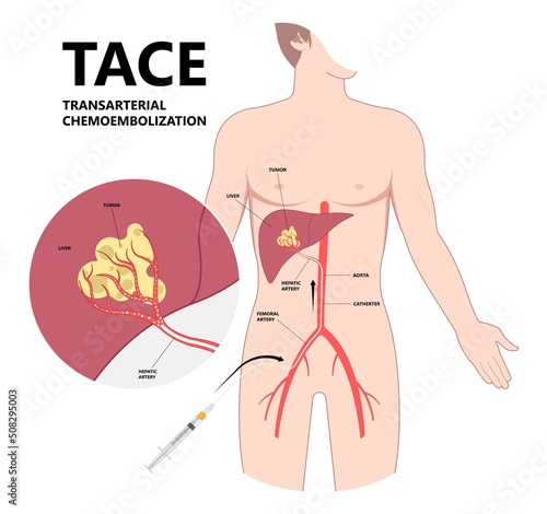 Transarterial chemoembolization or TACE treat embolization hepatic radio frequency for type A B C biliary atresia infusion