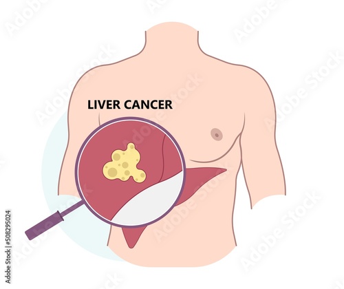 Transarterial chemoembolization or TACE treat embolization hepatic radio frequency for type A B C biliary atresia infusion photo