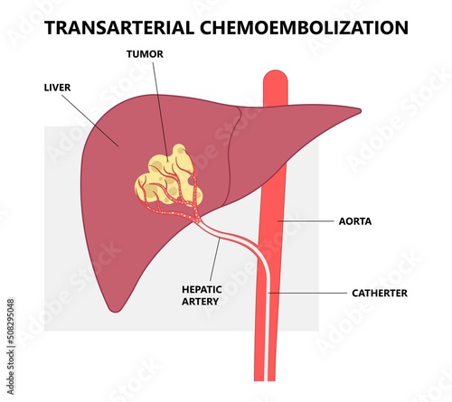 Transarterial chemoembolization or TACE treat embolization hepatic radio frequency for type A B C biliary atresia infusion