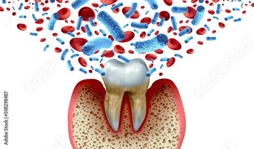 Tooth decay and blood bacteria and disease as an unhealthy molar with periodontitis due to poor oral hygiene health problem as a bacterial infection with inflammation photo