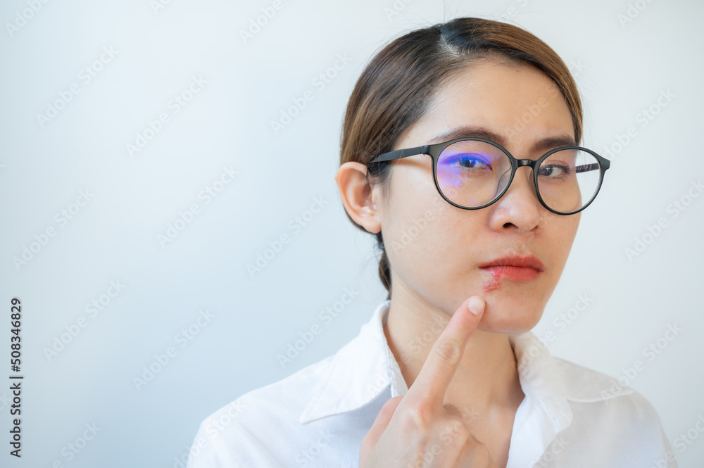 Asian woman pointing to Herpes labialis occur on her lower lip.