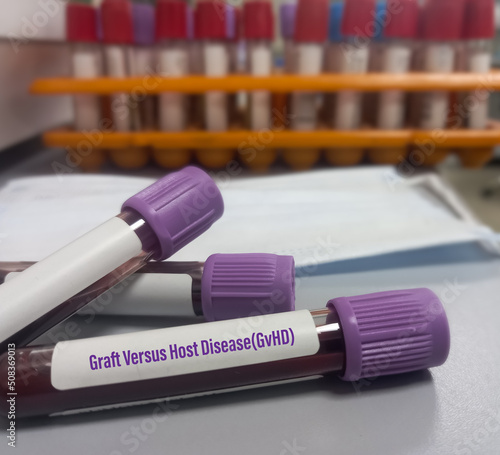 Blood sample for Graft versus host disease(GvHD). condition that might occur after an allogeneic transplant which someone receives bone marrow tissue or cells from a donor.