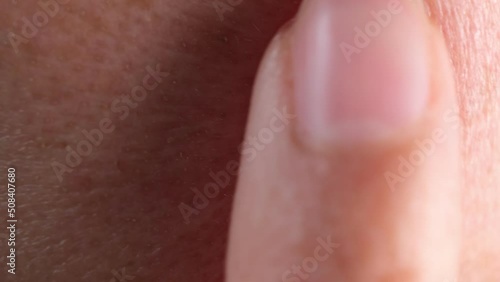 Human skin. Close up. common skin diseases include: Acne, blocked skin follicles that lead to oil. Atopic dermatitis, dry, itchy skin that leads to swelling, cracking or scaliness.