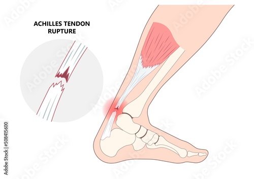 Rupture of Achilles tendon injury Feet calf test range of motion slight ache problem limb Thompson Simmonds torn photo