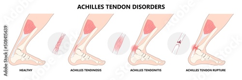 Small tear of Achilles tendon injury Feet calf test range of motion slight ache problem limb Thompson Simmonds and torn Rupture photo