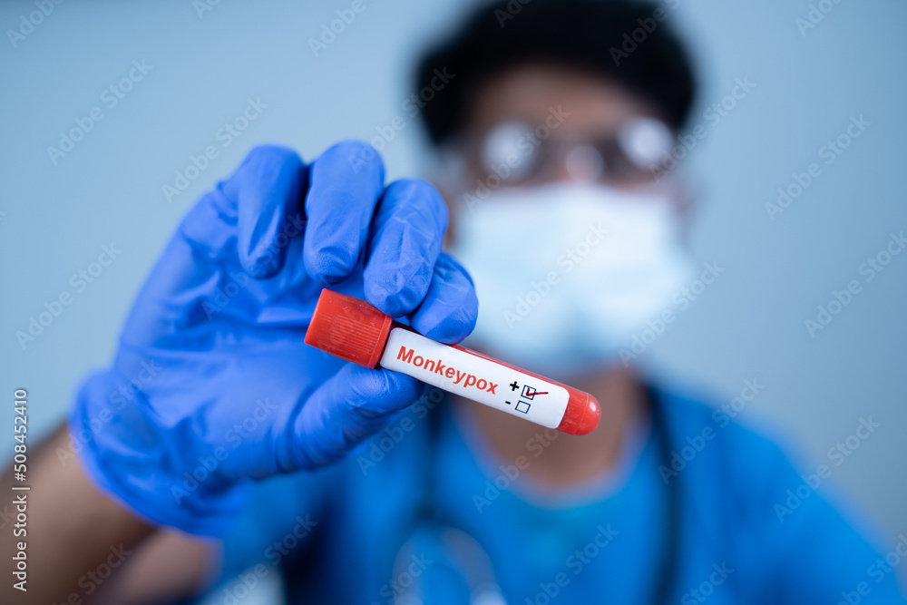 close up shot of doctor showing Monkeypox positive test of laboratory blood sample - concept of virus outbreak or spreading infection close up shot of doctor showing Monkeypox positive test of laboratory blood sample - concept of virus outbreak or spreading infection