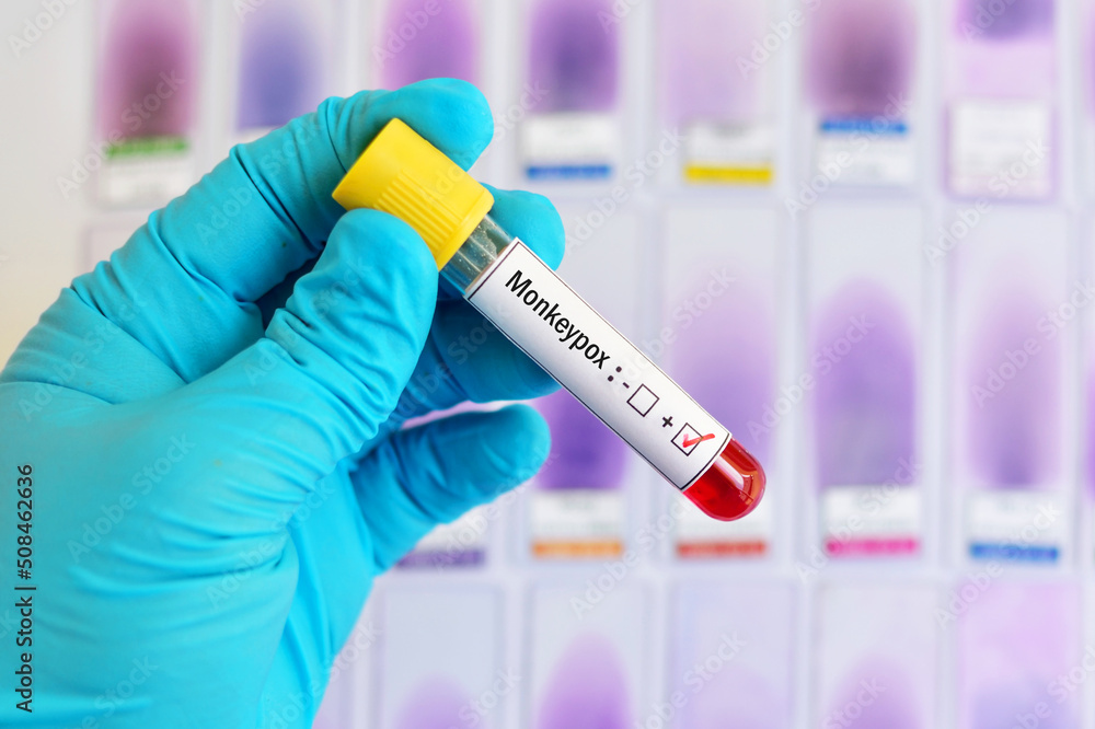 Blood sample tube positive with Monkeypox virus, new epidemic disease in 2022 Blood sample tube positive with Monkeypox virus, new epidemic disease in 2022