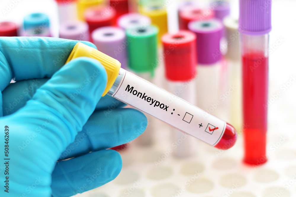 Blood sample tube positive with Monkeypox virus, new epidemic disease ...