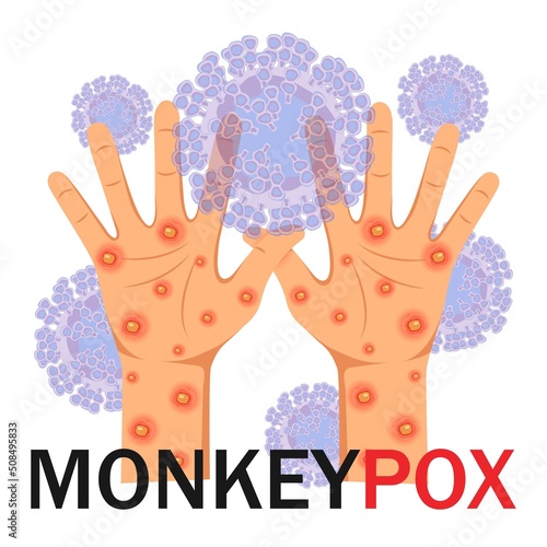 Monkeypox virus. Human hands with a rash on a microbiological background with text. Monkeypox concept. Vector illustration.