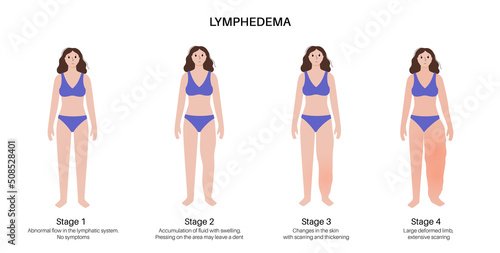 Stages of lymphedema photo