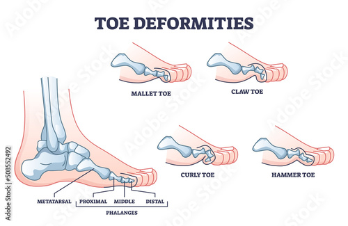 Toe deformities and foot phalanges bone defects outline diagram. Labeled educational scheme with proximal, middle and distal skeleton and mallet, claw, curly or hammer examples vector illustration.