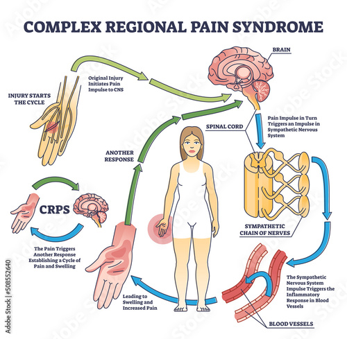 Complex regional pain syndrome or CRPS as painful condition outline diagram. Labeled educational arm or leg swelling cycle with body response vector illustration. Sympathetic nervous system impulse.