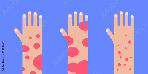 Hand with psoriasis wounds. People suffering from psoriasis banner vector illustration.