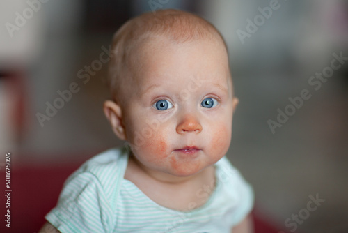 Cute little baby with atopic skin. Allergy and health.