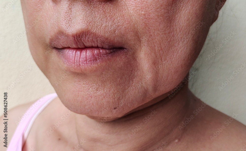 Portrait showing the flabbiness skin beside the mouth, wrinkles and flabby skin on the face, problem dark spots and blemish skin of the woman , concept health care. Portrait showing the flabbiness skin beside the mouth, wrinkles and flabby skin on the face, problem dark spots and blemish skin of the woman , concept health care.