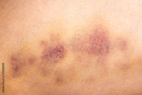 Bruises on the human body. Severe bruise from impact, bruising and hematoma. photo
