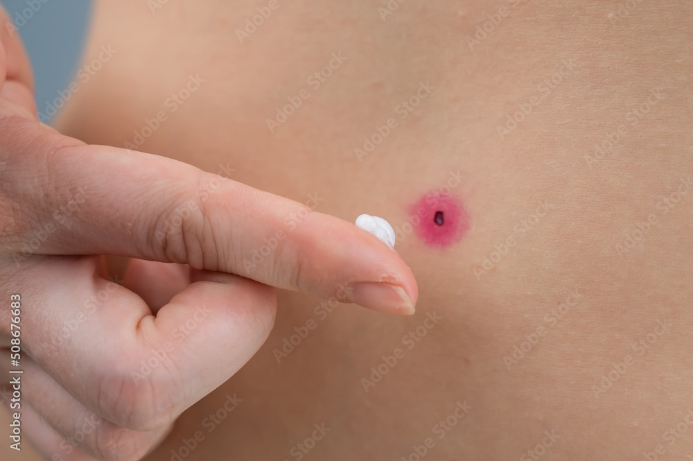 A woman smears cream on a wound after burning a wart. A woman smears cream on a wound after burning a wart.