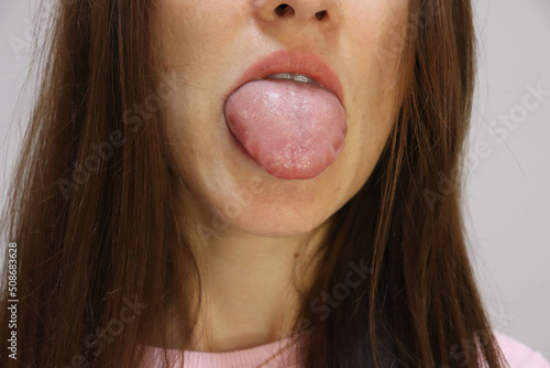 Fotografia Young woman showing swollen tongue after Quincke's edema or Allergy