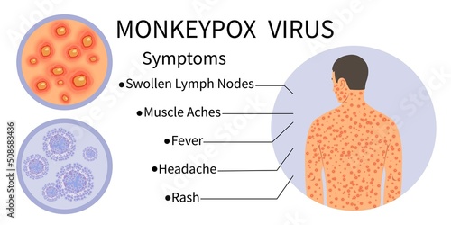 Monkeypox virus banner for symptom awareness. Monkeypox virus symptoms infographic. Human body with rash. Symptoms of the disease - Swollen Lymph Nodes, Muscle Aches, Fever, Headache, Rash.Vector.