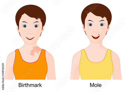 Mole and Birthmark. Comparison and difference