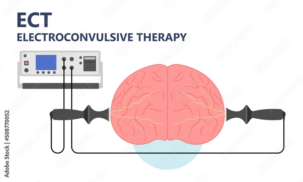ECT treat the MDD and Major TMS electric current brain mental health