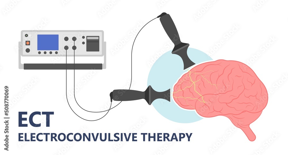 ECT treat the MDD and Major TMS electric current brain mental health