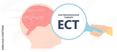 ECT treat the MDD and Major TMS electric current brain mental health mania bipolar loss Physical head EEG activity signal severe OCD therapist shock deep anxiety Post disease emotional Stigma