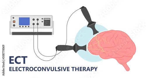 ECT treat the MDD and Major TMS electric current brain mental health mania bipolar loss Physical head EEG activity signal severe OCD therapist shock deep anxiety Post disease emotional Stigma photo