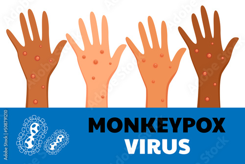 Monkeypox virus poster. Web banner of monkey pox skin infection of person. Vector Illustration. photo