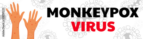Monkeypox virus poster. Web banner of monkey pox skin infection of person. Vector Illustration.