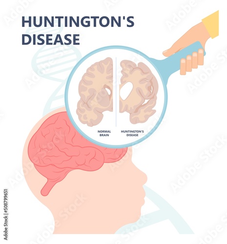 Huntington parkinson Motor alzheimer neuron brain DNA gene nerve cell juvenile problem defect genetic basal ganglia neuro repeat mutant damage testing defective mood inherits system family memory loss