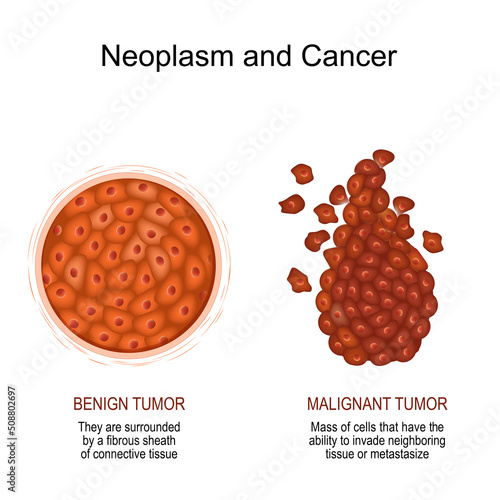 Neoplasm and Cancer. malignant and benign tumor.