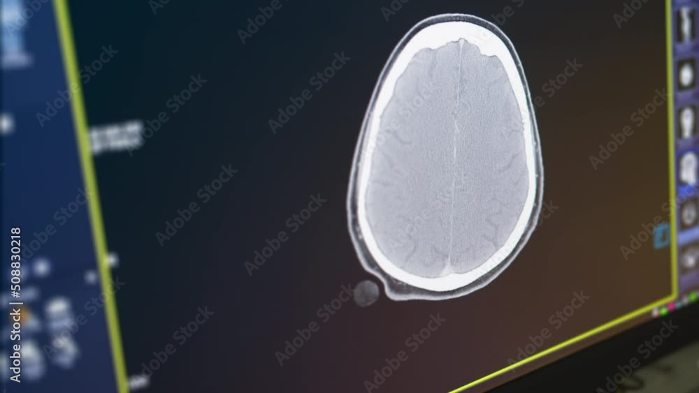 MRI of the brain in sagittal plane with contrast media. magnetic ...