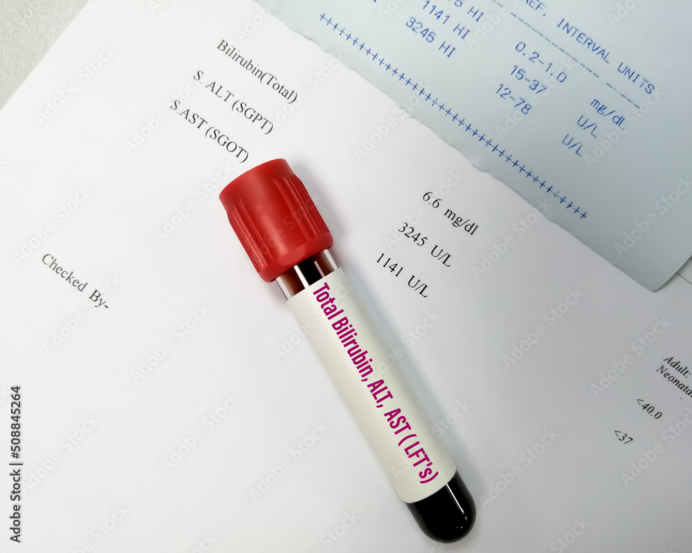 Blood sample for ALT, AST and Total Bilirubin test with abnormal report. LFTs or Liver Function