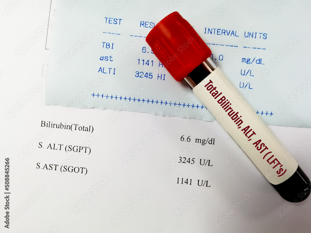 Blood sample for ALT, AST and Total Bilirubin test with abnormal report
